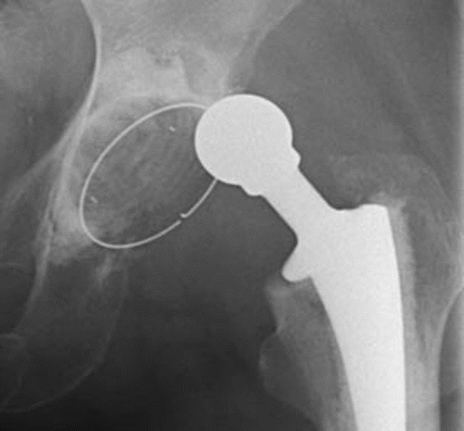 Geluxeerde heup. De kop bevindt zich naast en niet in de kom.