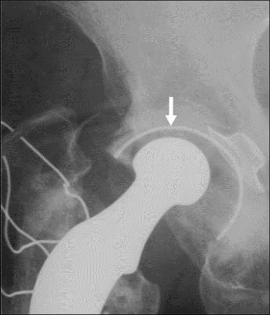 Op deze afbeelding ziet men slijtage van de polyethyleen glijlaag van de pan waardoor de heupkop niet meer centraal in de pan gepositioneerd zit.