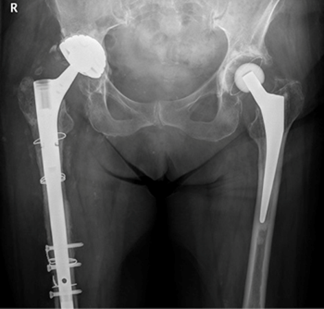 De lange steel is een revisiesteel.