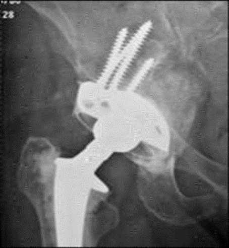 De pan met schroeven is een revisiepan.